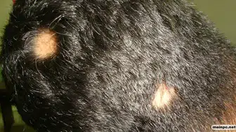 Saçkıran hastalarına yeni umut ! Upadacitinib ile belirgin iyileşme görüldü