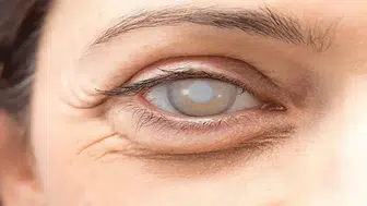 Kataraktın günlük yaşamdaki etkileri nedir ve neden zorlanıyoruz ?
