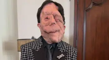 Adam Pearson kimdir, kaç yaşında ve hastalığı nedir? Oscar’a damga vuran oyuncunun biyografisi