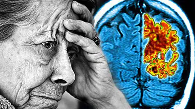 Bilim dünyasından yeni keşif: Alzheimer önlenebilir mi?