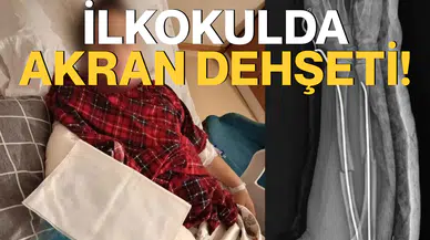 9 yaşındaki çocuk arkadaşının kolunu iki yerinden kırdı