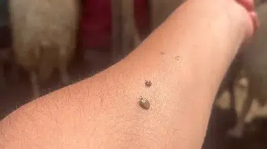 Kayseri'de kene ısırması sonucunda hayatını kaybedenlerin sayısı 6'ya yükseldi