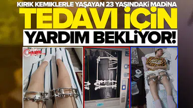 Kırık kemiklerle yaşayan 23 yaşındaki Madina, tedavi için yardım bekliyor!