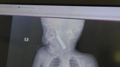 Karaman’da korku dolu anlar: Boğazına pil kaçan 6 aylık bebek ameliyatla kurtarıldı