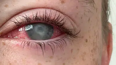 Kontak lens kullanıcılarını bekleyen gizli tehlike: Körlüğe yol açan parazit hastalığı nasıl bulaşır?