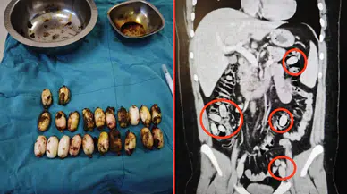 Midesinde 44 kapsül uyuşturucu taşıyan şahıs, polislerin dikkati sayesinde yakalandı