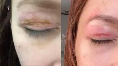 Güzellik salonundaki işlem sonrası gözünde hasar iddiası : Şikayeti reddedildi