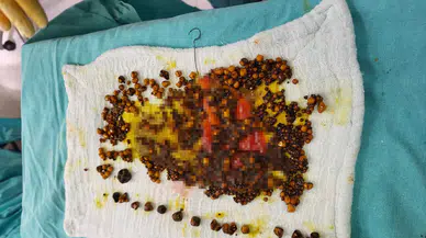 Manisa'da karın ağrısı şikayetiyle hastaneye gitti, safra kesesinden birçok taş çıkarıldı