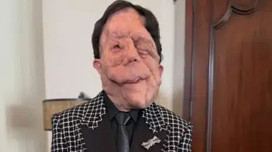 Adam Pearson kimdir, kaç yaşında ve hastalığı nedir? Oscar’a damga vuran oyuncunun biyografisi