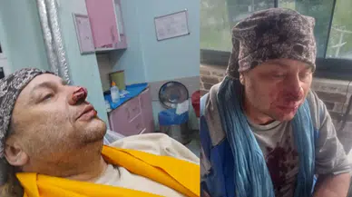 Sanatçı Onur Akay'a pitbull saldırdı : Burnundan parça koptu