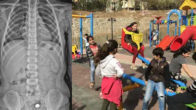 Parkta bulduğu pili şeker sanıp yuttu : 4 yaşındaki çocuğun midesi yandı