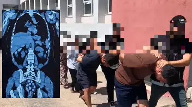 Adana'da midelerinden 1,5 kilo uyuşturucu çıktı