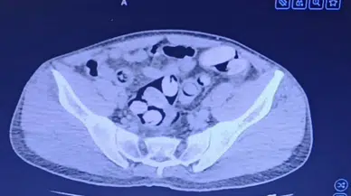 Kırşehir'de bir şahsın midesinden 1 kilo uyuşturucu çıktı