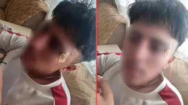 Öğretmenin kafa attığı 16 yaşındaki çocuğun burnu kırıldı