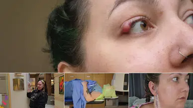 Göz kapağındaki şişliği arpacık sandı, nadir kanser teşhisi konuldu: Tükürük bezi kanserinin belirtileri neler?