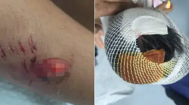 Viranşehir'de Okul Dönüşü Köpek Dehşeti: Çocuğun Başına 15 Dikiş Atıldı