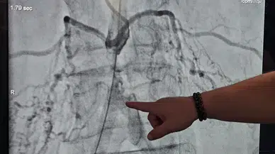 Bel Fıtığı Şikayetiyle Başvurdu, Ana Damarının Tıkalı Olduğu Anlaşıldı