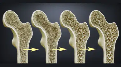 D vitamini takviyesi yeterli mi? İleri yaşlarda osteoporoz riski artıyor