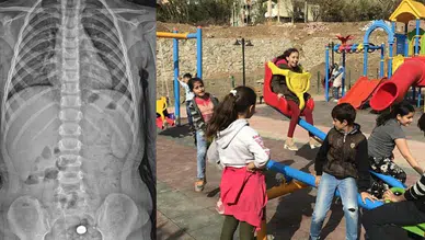 Parkta bulduğu pili şeker sanıp yuttu : 4 yaşındaki çocuğun midesi yandı