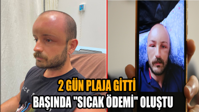 Tatilciler dikkat! 2 gün plaja gitti, başında ''sıcak ödemi'' oluştu
