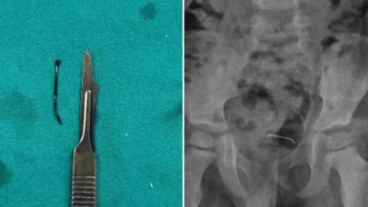 5 yaşındaki çocuğun yuttuğu iğne 9 ay sonra ameliyatla çıkarıldı