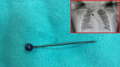 5 yaşındaki çocuk toplu iğne yuttu!