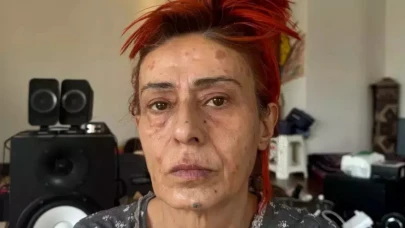 Yıldız Tilbe saç boyası kurbanı olmuştu! Son durumunu açıkladı