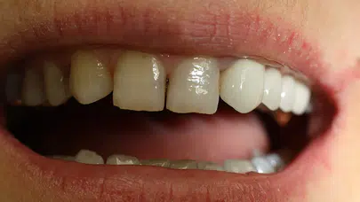 Diş eksikliği baş dönmesi yapar mı? Uzmanlardan vertigo ve kulak çınlaması uyarısı