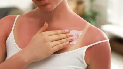 Uzman isimden kritik uyarı: Güneş alerjisine dikkat!