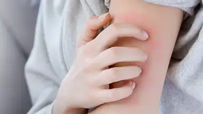 Sosyete uyuzu nedir? Temiz insanlarda bile görülüyor! İşte sosyete uyuzunun belirtileri ve bulaşma yolları