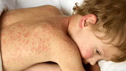 Soğuk algınlığı gibi başlıyor, körlüğe kadar götürebiliyor! Uzmanlardan kızamık uyarısı!