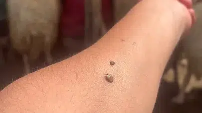 Kayseri'de kene ısırması sonucunda hayatını kaybedenlerin sayısı 6'ya yükseldi