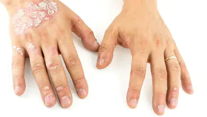 Cilt hastalıklarına şifa arayanların yeni gözdesi: Binlerce kişi o plaja gidiyor!