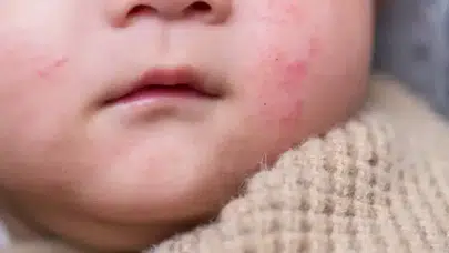 Besin alerjileri çocuklarda salgın gibi yayılıyor