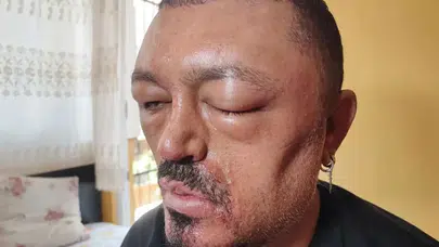 İnternetten aldığı şampuan kabusu oldu! Güzellik uğruna gözlerini kaybediyordu