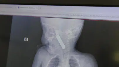 Karaman’da korku dolu anlar: Boğazına pil kaçan 6 aylık bebek ameliyatla kurtarıldı