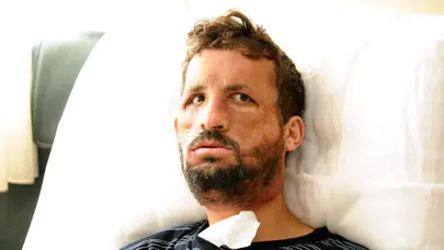 Türkiye’nin ilk yüz nakli Uğur Acar 14. yılında! 'Yüzünü aldığım kişinin yaşındayım'