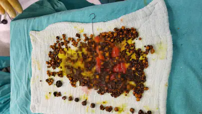 Manisa'da karın ağrısı şikayetiyle hastaneye gitti, safra kesesinden birçok taş çıkarıldı