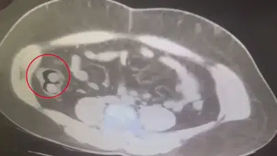 Kars'ta yakalanan kuryenin midesinden 76 kapsül uyuşturucu çıktı