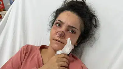 Manisa’da eşinin ısırarak kopardığı burnu ameliyatla dikildi