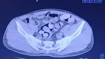 Kırşehir'de bir şahsın midesinden 1 kilo uyuşturucu çıktı