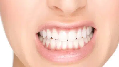 Dişlerinizi Sararmaktan Kurtaran Doğal Yöntemler Nelerdir?