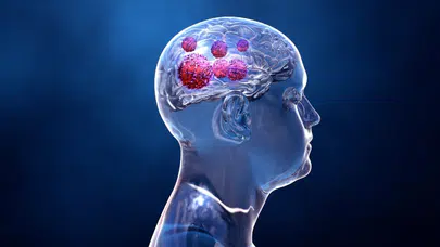 Yeni bir burun spreyi yöntemiyle beyin tümörleri tedavi edilebilir mi?