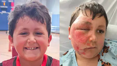 Sosyal medya trendleri kabusu yaşattı : Oyuncak yüzünde patladı