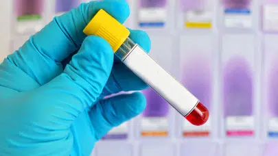 Alzheimer riskini öngören yeni bir kan testi yolda! Tam olarak ne zaman hazır olacak?