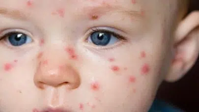 Kızamık vakaları neden bu kadar artıyor? DSÖ verileri ne diyor?