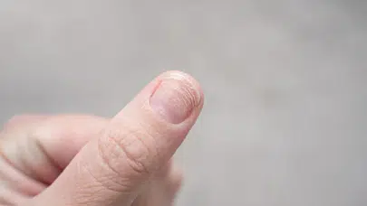 Tırnak diplerindeki renk değişimi neden olur ? Hangi hastalığın habercisi ?
