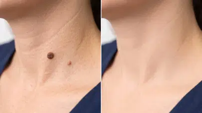 Et benleri neden oluşur ve kendiliğinden düşer mi ?