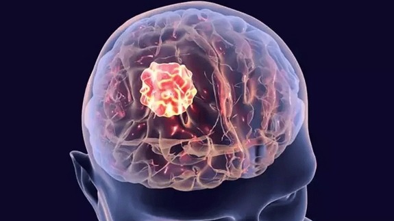 Çocuklarda beyin tümörünün sinyallerine dikkat!