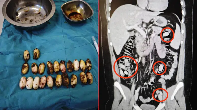 Midesinde 44 kapsül uyuşturucu taşıyan şahıs, polislerin dikkati sayesinde yakalandı